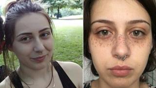 Жена едва не остана с белези за цял живот, след като си сложи лунички като на Меган Маркъл