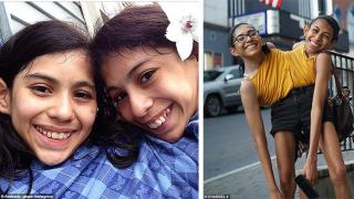 18-годишни сиамски близначки отказват да бъдат хирургически разделени и дори карат шофьорски курс заедно (видео и снимки)