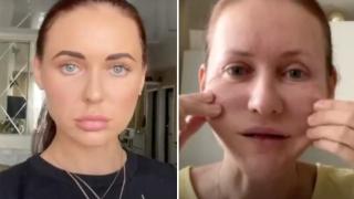 Кошмарна разкрасителна процедура "мумифицира" лицето на рускиня (видео и снимки)