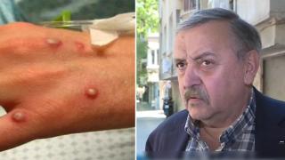 Какви са симптомите на маймунската шарка? (видео)