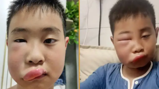 Момченце бръкна с пръчка в кошер с пчели и плати с подуто до неузнаваемост лице (видео)