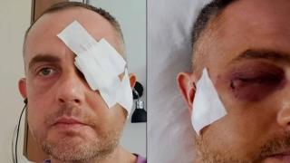 Мъж от Враца е с комоцио и счупена скула след нападение и побой (видео)
