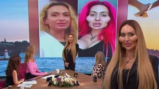 Жената с най-големи скули в света с поредна  разкрасителна процедура (видео)