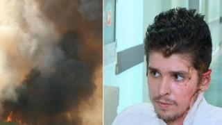 Пострадалият при пожарите в Сакар 19-годишен доброволец вече си е у дома (видео)