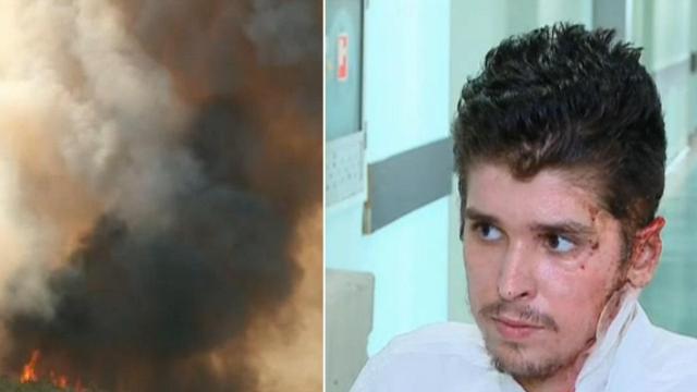 Пострадалият при пожарите в Сакар 19-годишен доброволец вече си е у дома (видео)