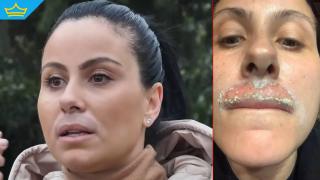 Процедура с лазер обезобрази жена в Благоевград (видео)