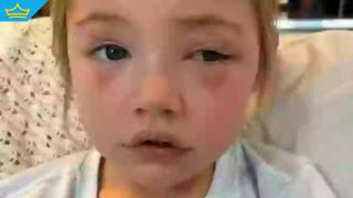 Австралийче остана без зрение на едното око, след като погълна често използван в домакинствата предмет