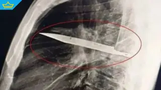 Мъж от Танзания е живял осем години с нож, забит в гърдите, без да подозира